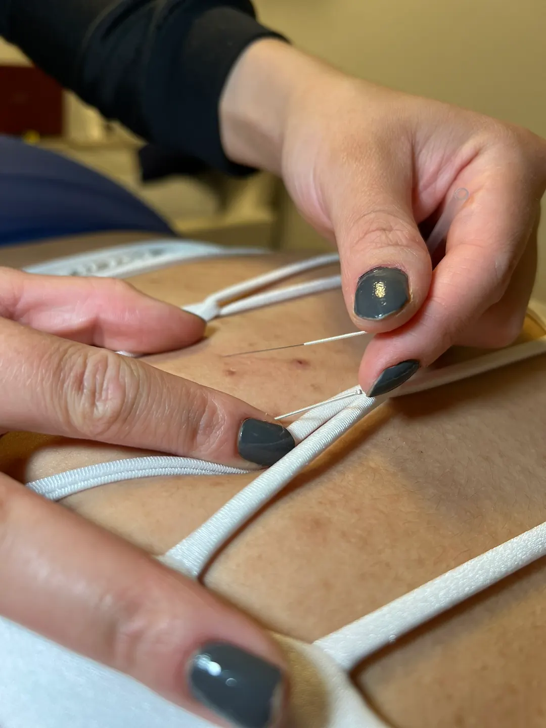 Aplicação de dry needling com agulhas finas em pontos-gatilho das costas
